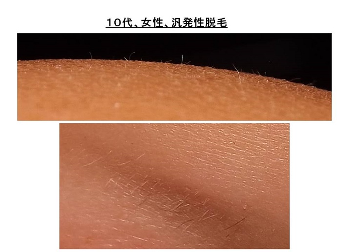 汎発性脱毛　病院""
